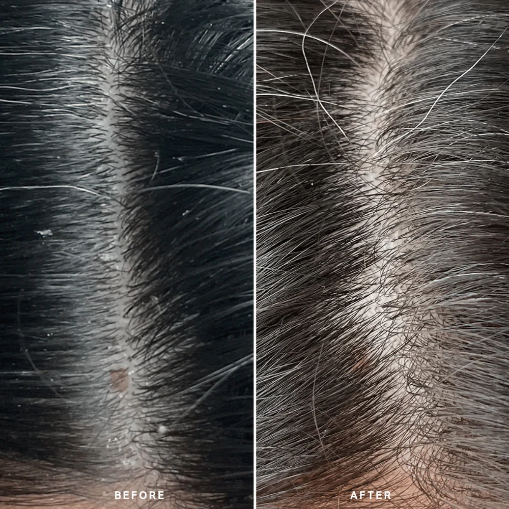 Alpha-H Healthy Scalp Exfoliating Treatment 100ml - Image 9