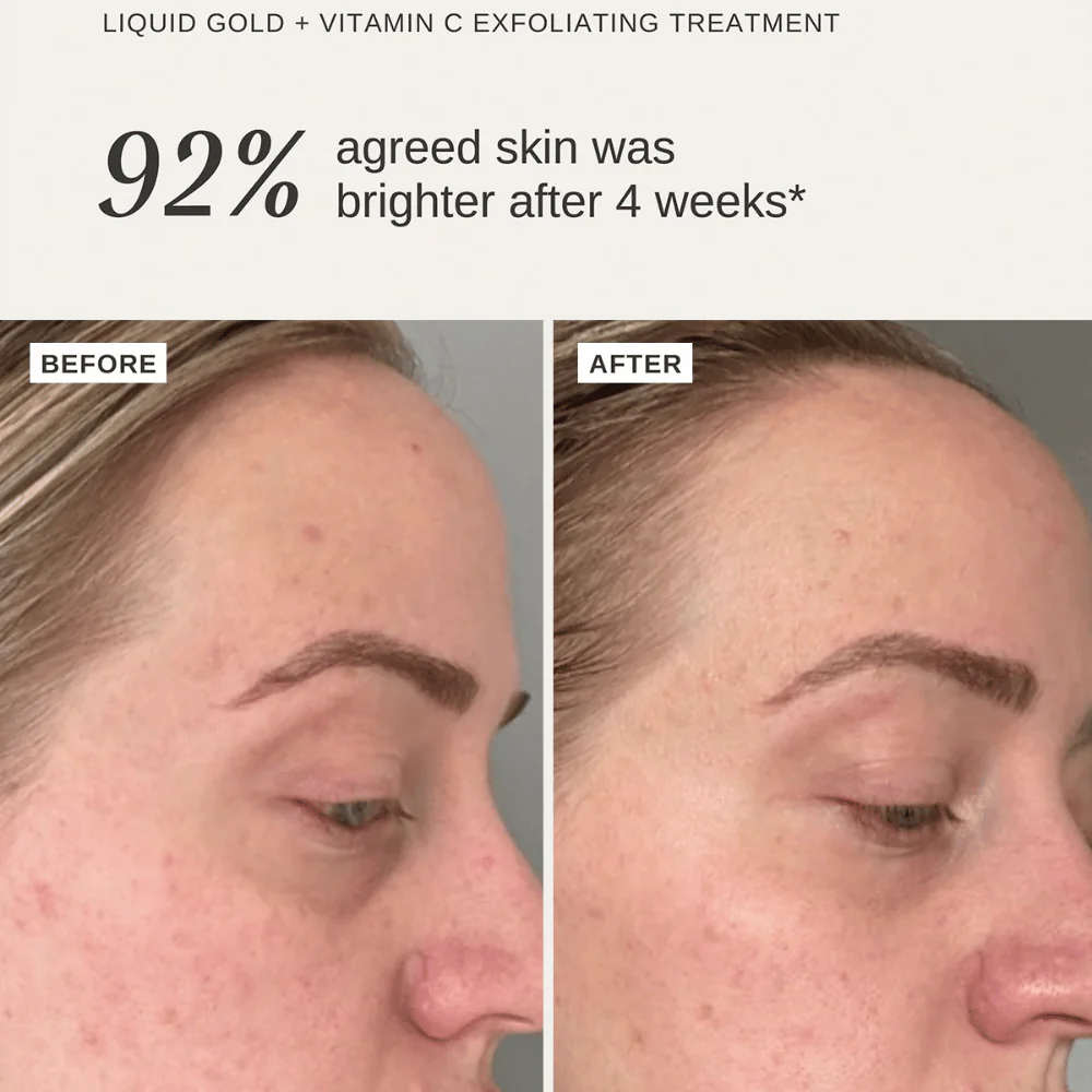 Alpha-H Liquid Gold + Vitamin C Trial Kit - Image 2
