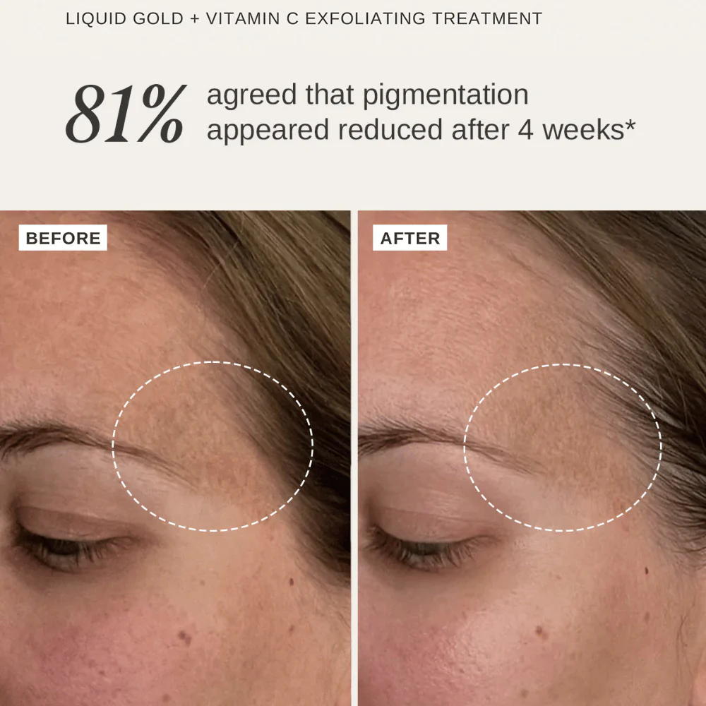 Alpha-H Liquid Gold + Vitamin C Trial Kit - Image 3