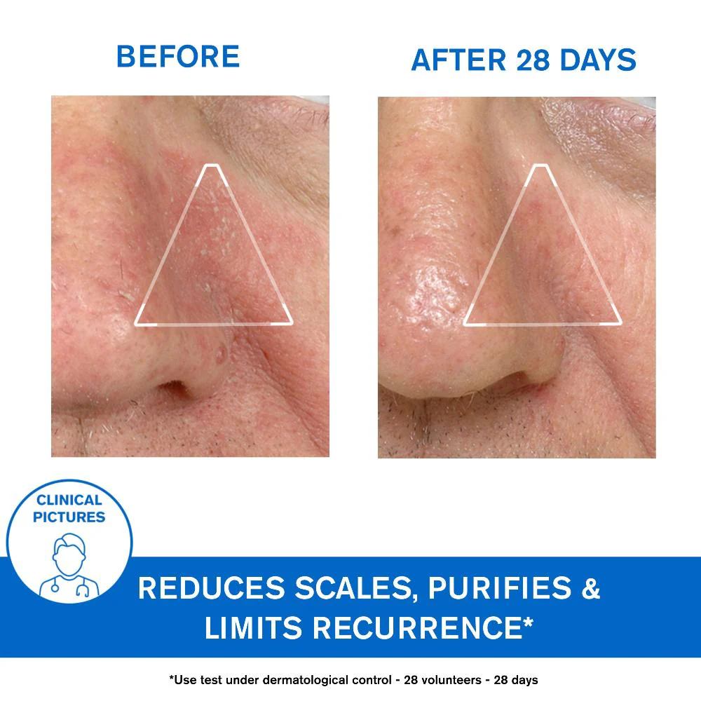Uriage D.S. Regulating Emulsion, Irritation, Redness, Scales 40ml - Image 5