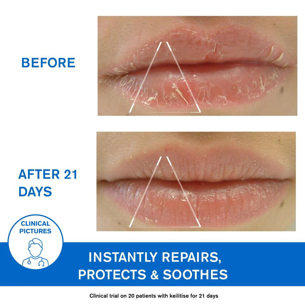 Uriage D.S. Regulating Emulsion, Irritation, Redness, Scales 40ml - Image 6
